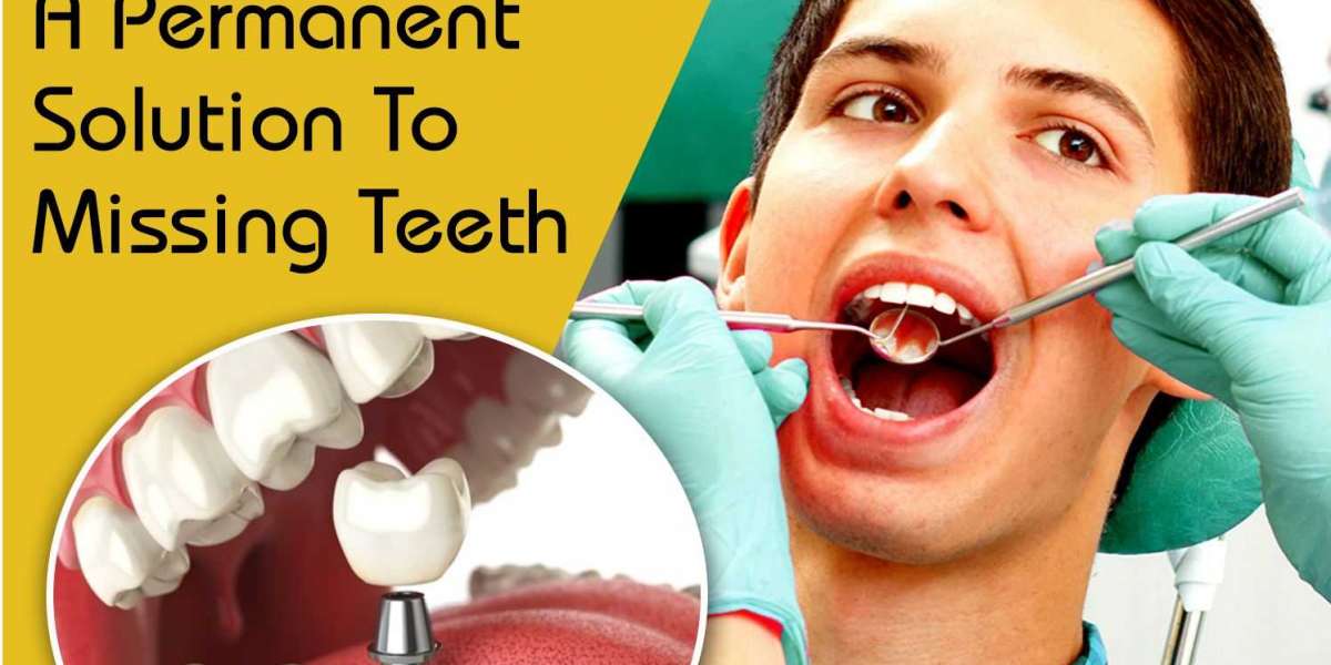 Cost Of Dental Implants- Best Dental Implant Clinic in West Delhi