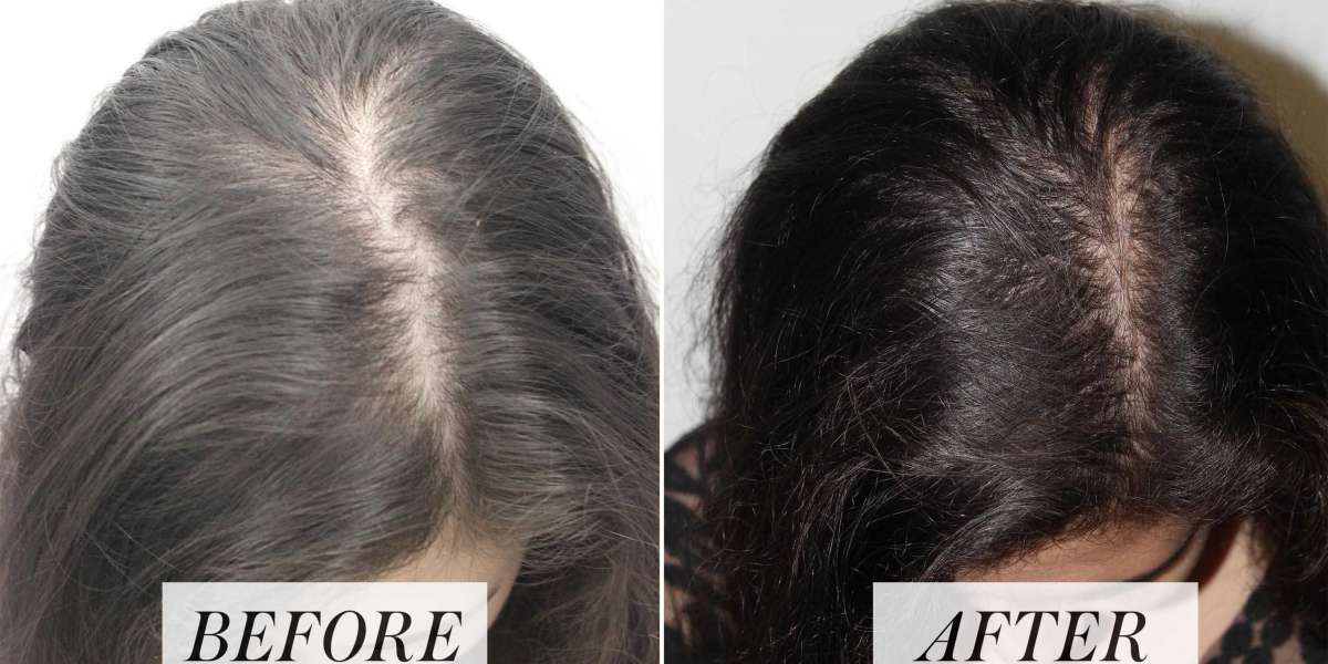 How much is prp hair loss treatment