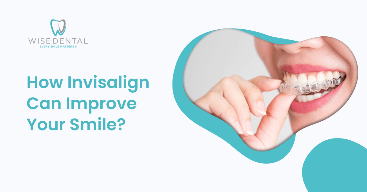 How Invisalign Can Improve Your Smile? - Wise Dental