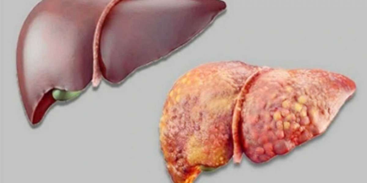 There are five symptoms of liver failure.