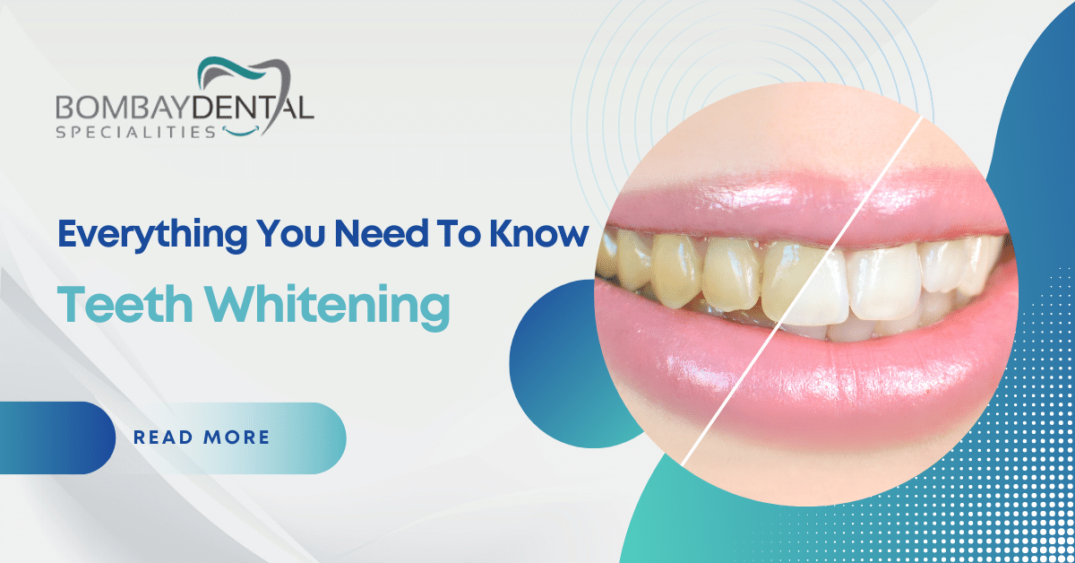 Teeth Whitening: Everything You Need to Know | Zupyak
