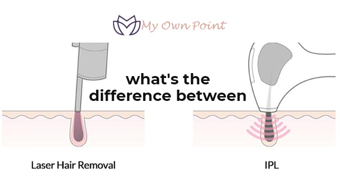 What's The Difference Between Laser Hair Removal And IPL