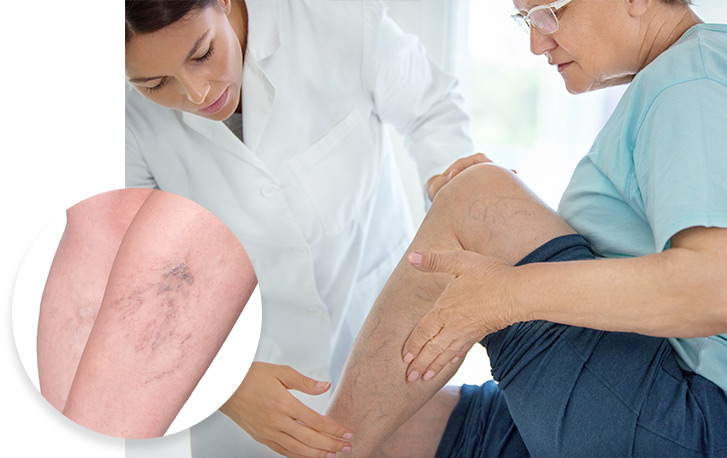 A Journey to Say Goodbye to Varicose Veins through Private Varicose Vein Treatment - Magzinenow