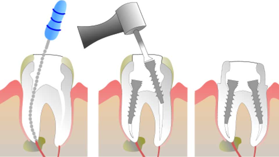 Root Canal Treatment for Front Teeth vs. Back Teeth: Key Differences - Trusted Blogs