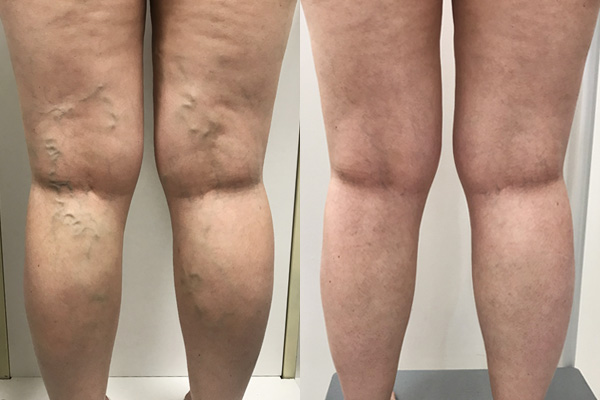 Which is the Best Among the Different Varicose Vein Treatments in the UK? | WayTess