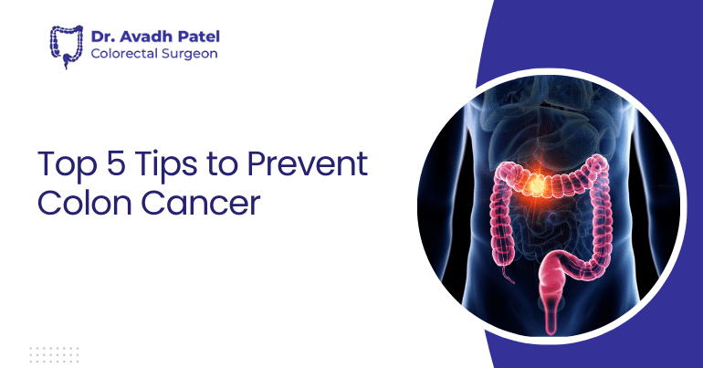 Top 5 Tips to Prevent Colon Cancer | Dr. Avadh Patel