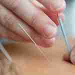 berkeley acupuncture
