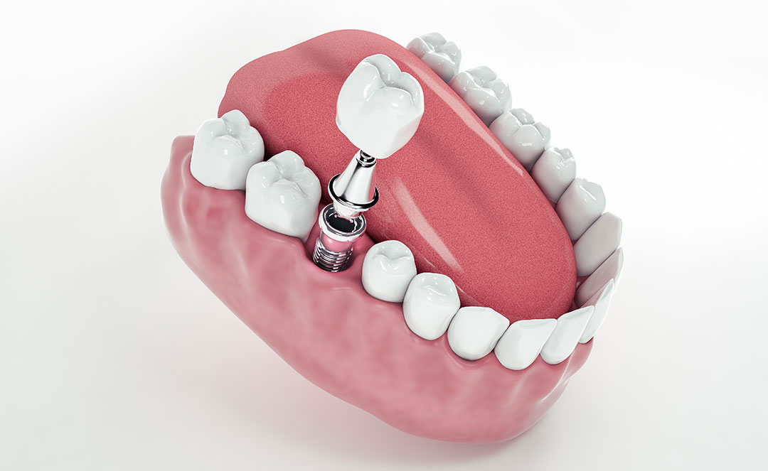 Dental Implants Brooklyn | Affordable Teeth Implants | Implant Dentist
