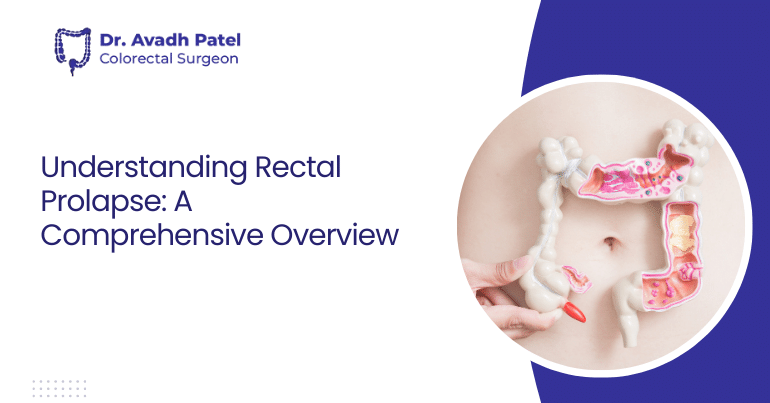 Understanding Rectal Prolapse: A Comprehensive Overview