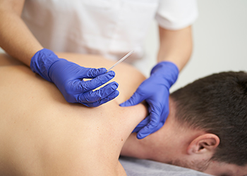 Dry Needling Therapy Edmonton | IMS Therapy | In Step Physio